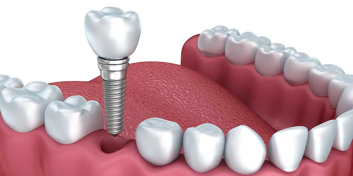 Single Tooth Implant