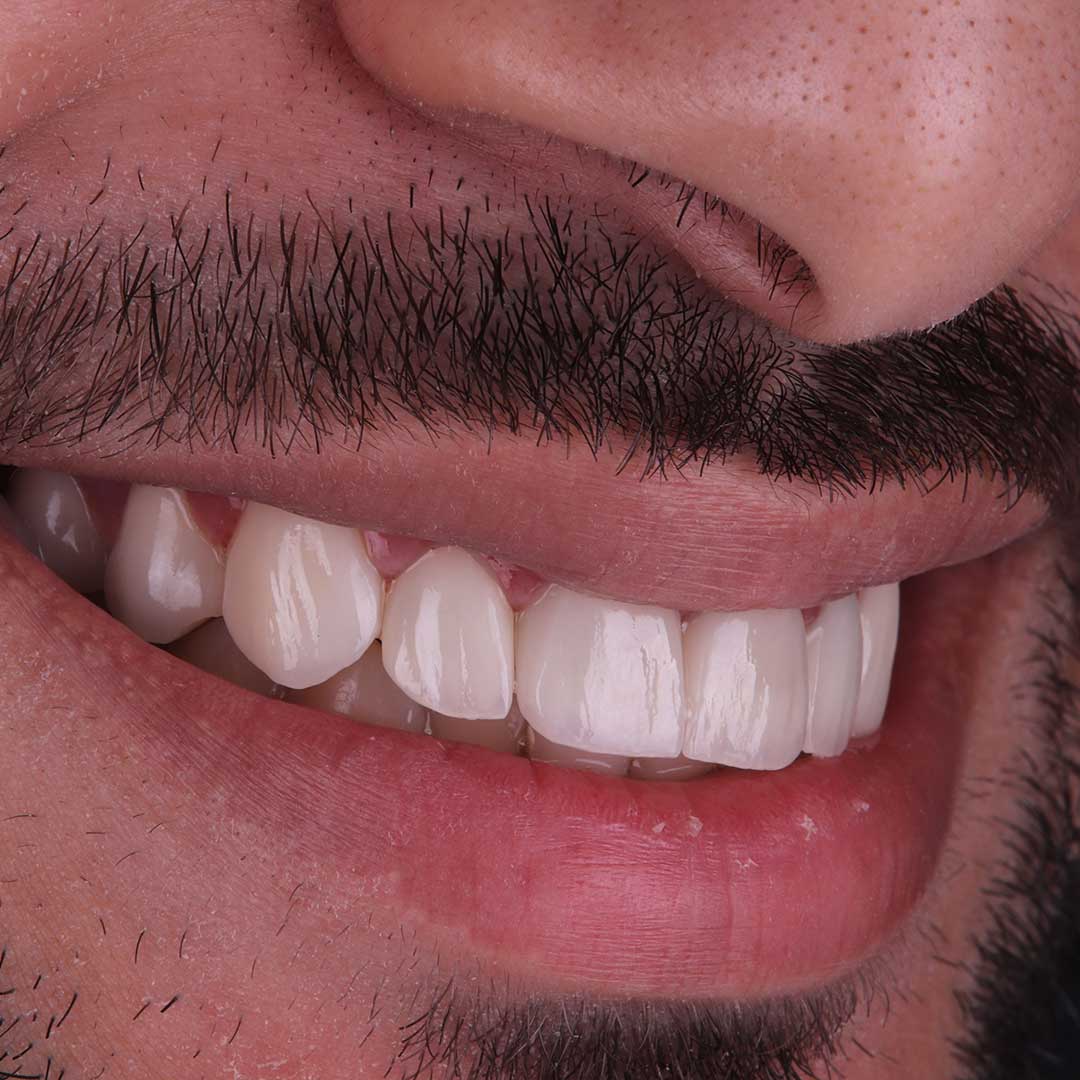 تنظيف الأسنان دبي